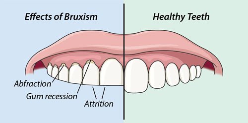 Ефекти од бруксизам: Повлекување на гингивата, Атриција (стругање на забите еден од друг)